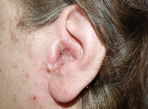 Dấu hiệu cảnh báo bệnh ung thư tai, có thể bạn chưa biết. 